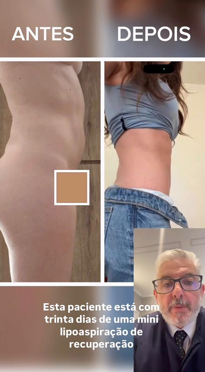Resultado Mini Lipo - 30 dias